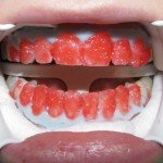 Нанесення гелю на зуби